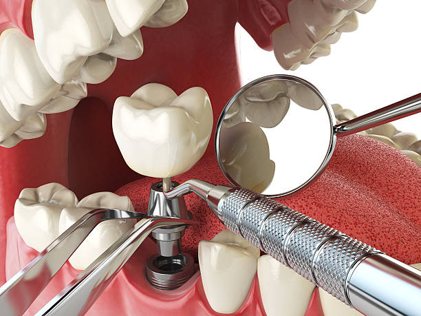 Best Urgent Care for Lost Fillings or Crowns in Emeryville, CA