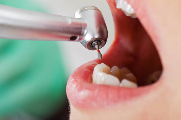 Best Emergency Wisdom Teeth Removal in Emeryville, CA